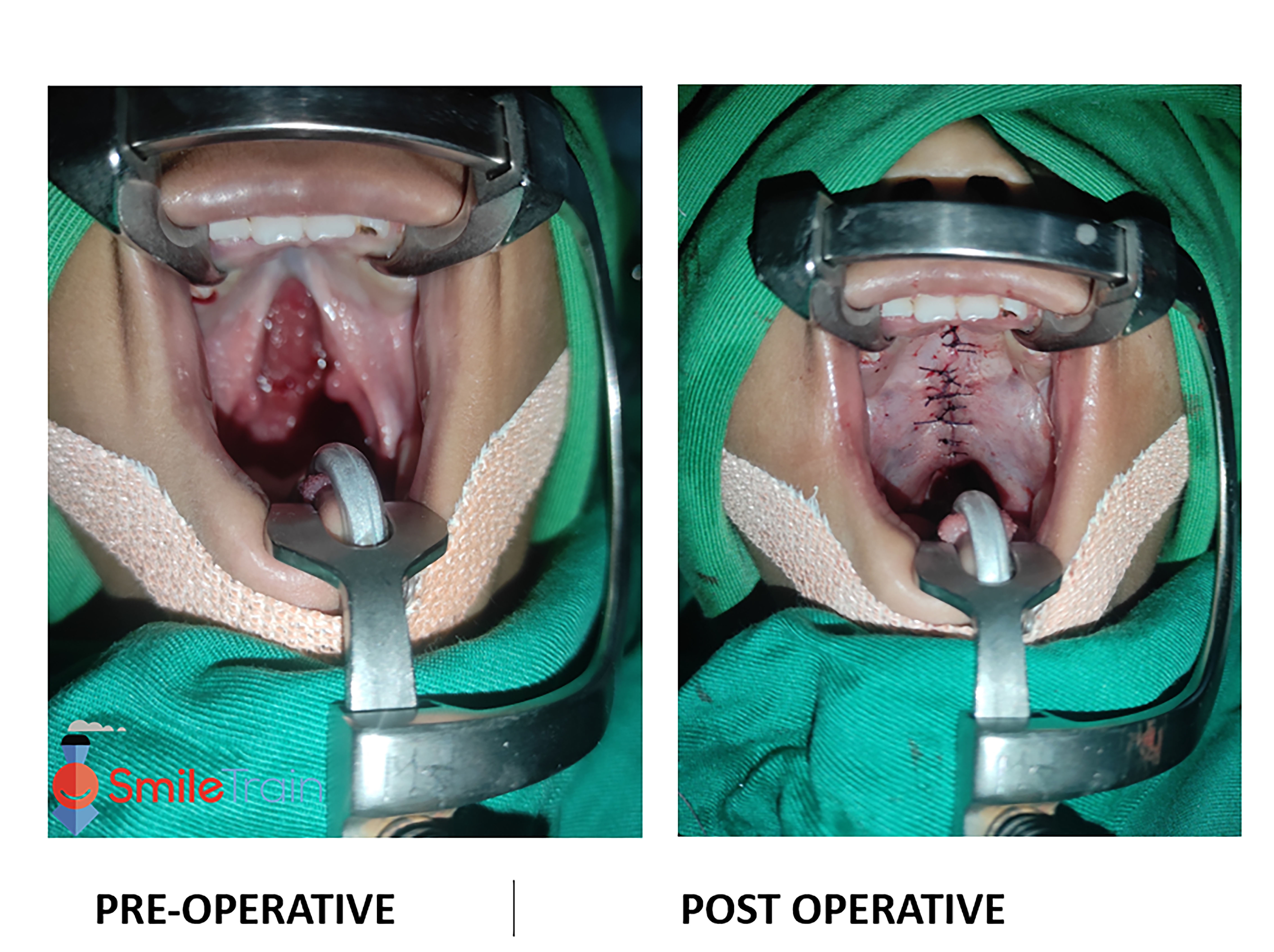 Cleft Palate